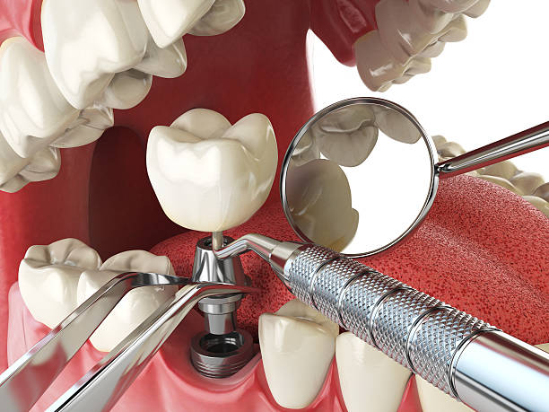 Best Emergency Dentist for Lost Fillings or Crowns in Minersville, PA